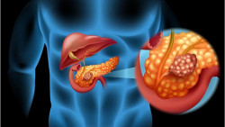 Científicos de EEUU afirman saber como parar el desarrollo del cáncer de páncreas