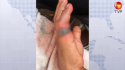 Casi pierde el dedo a causa de un anillo