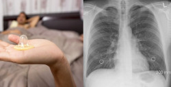 Creían que esta mujer de 27 años tenía tuberculosis, pero era un condón atorado en sus pulmones