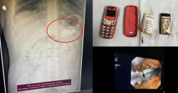 Hombre va a hospital por dolores y le encuentran un Nokia 3310 en su estómago