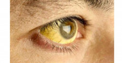 La OMS alerta de un brote de fiebre amarilla en Venezuela