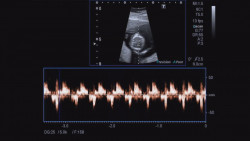 La SSA no tendrá problema para atender mujeres que decidan abortar