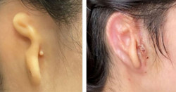 Mujer recibe oreja impresa en 3D hecha con sus propias células