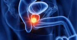 7 de cada 10 hombres son  diagnosticados  con cáncer de próstata