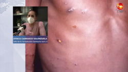 No se han detectado casos de viruela del mono en el sur; instalan módulos en centros turísticos