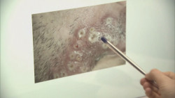 Esperan resultado de laboratorio por viruela del mono