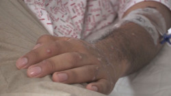 3 casos activos de Viruela del Mono en Sinaloa